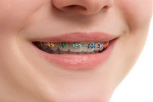 Fixed Metal Braces